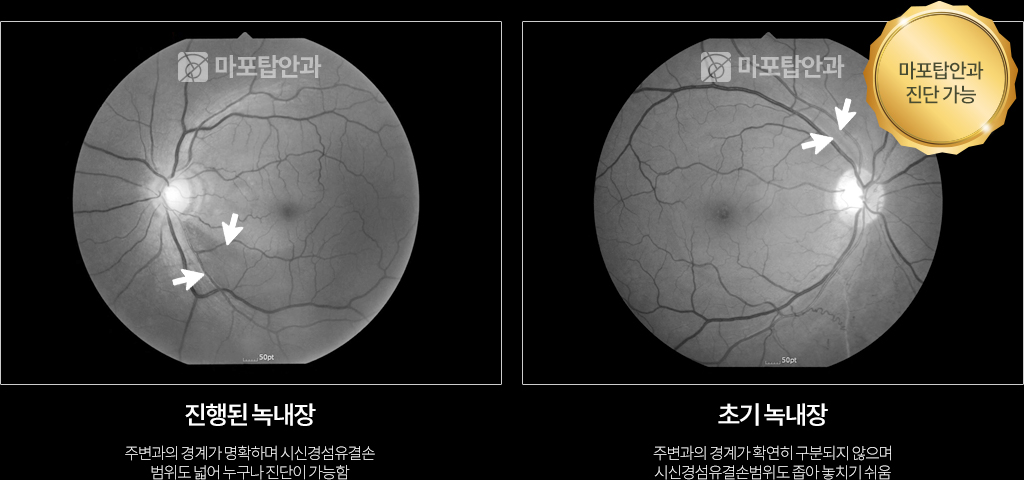 마포탑안과 녹내장 정밀 진단 시스템