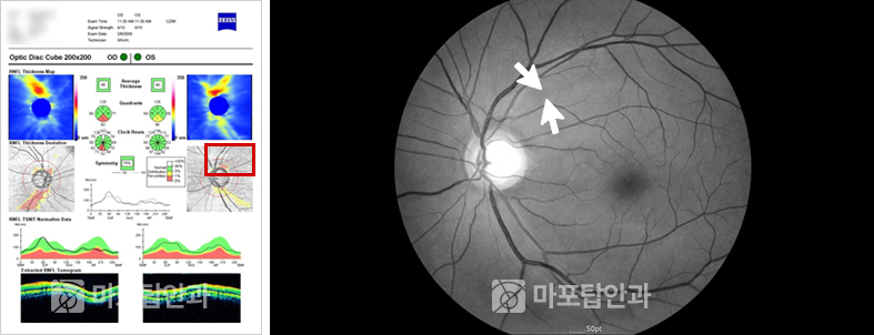사례 1: 정상 판독 뒤에 숨은 초기 녹내장
