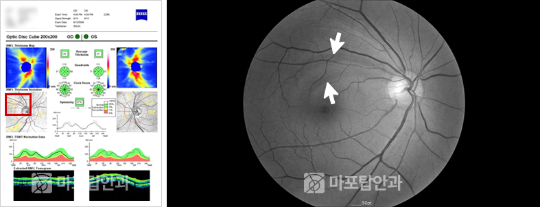 사례 2: 저위험군 판독 오류